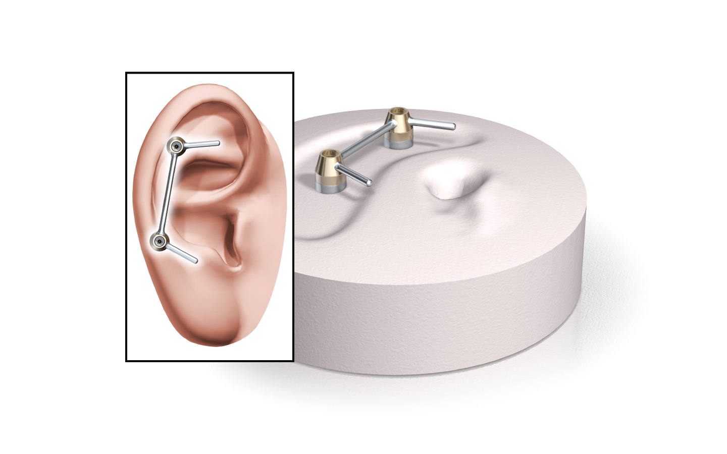 Illustrazione degli impianti del sistema Vistafix e della protesi all’orecchio